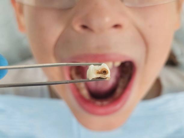 Best Emergency Dental Care for Broken or Chipped Teeth in Eclectic, AL